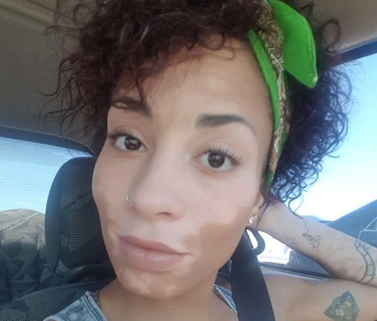 Ghanaian woman tattoos her Vitiligo Marks to honour her Ghanaian Heritage Before her skin turns all white