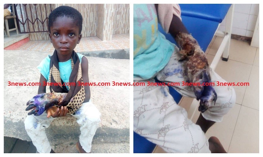 So Sad: Step mum leaves 5yr-old boy’s arm to rot after she accidentally cut it