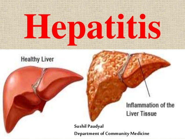 Hepatitis: Types, Causes, Effects On The Body, Treatment And Prevention