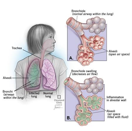 Pneumonia: Overview, Types, Causes, Risk factors, Signs And Symptoms, Prevention And Complications
