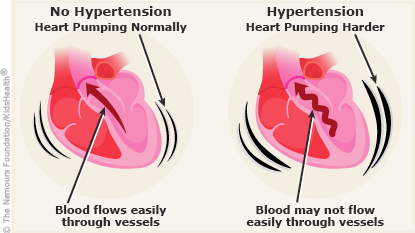 Hypertension: Causes, Types And Ways Of Prevention