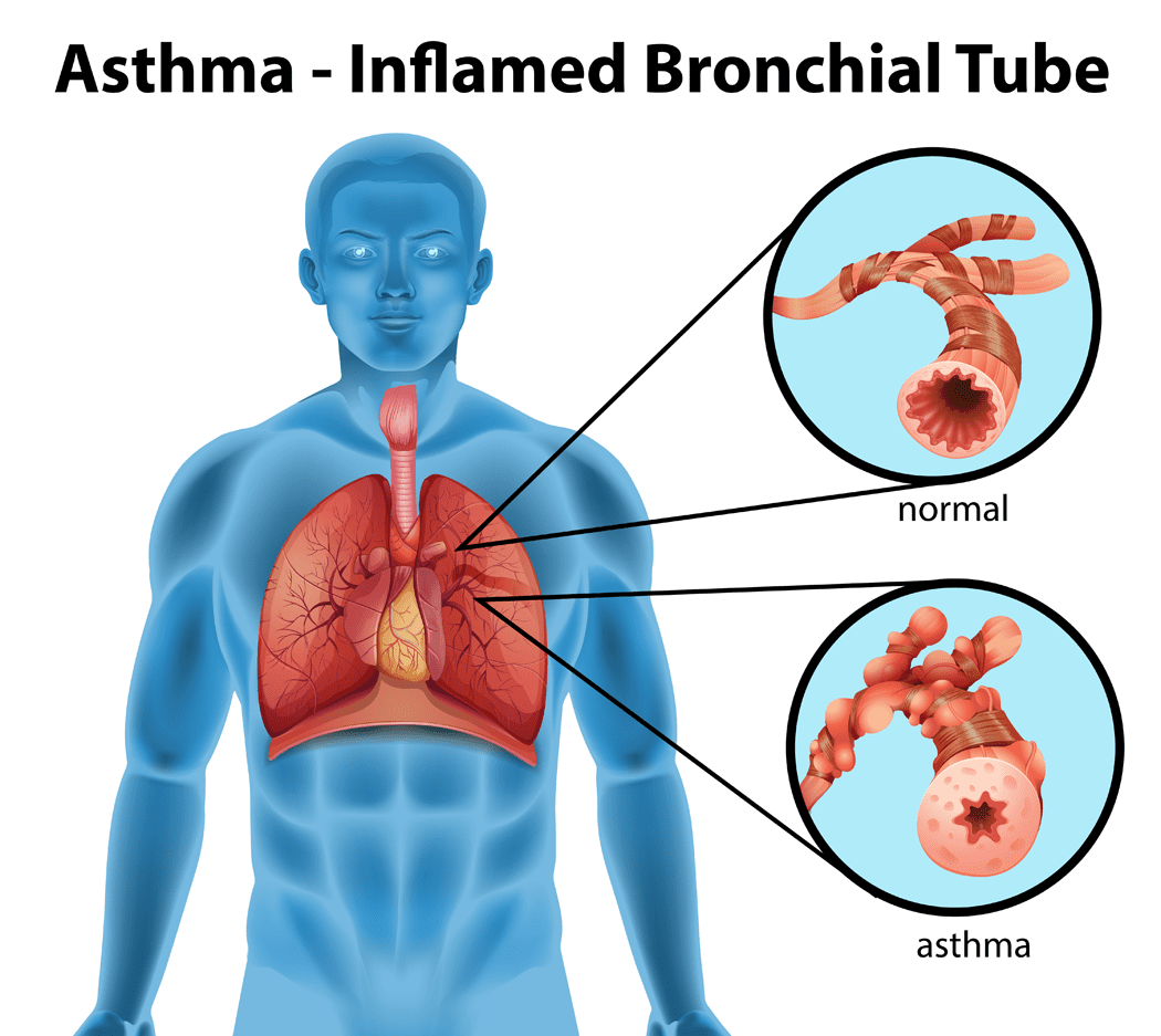Asthma: Overview, Causes, Signs And Symptoms And Treatment/Management