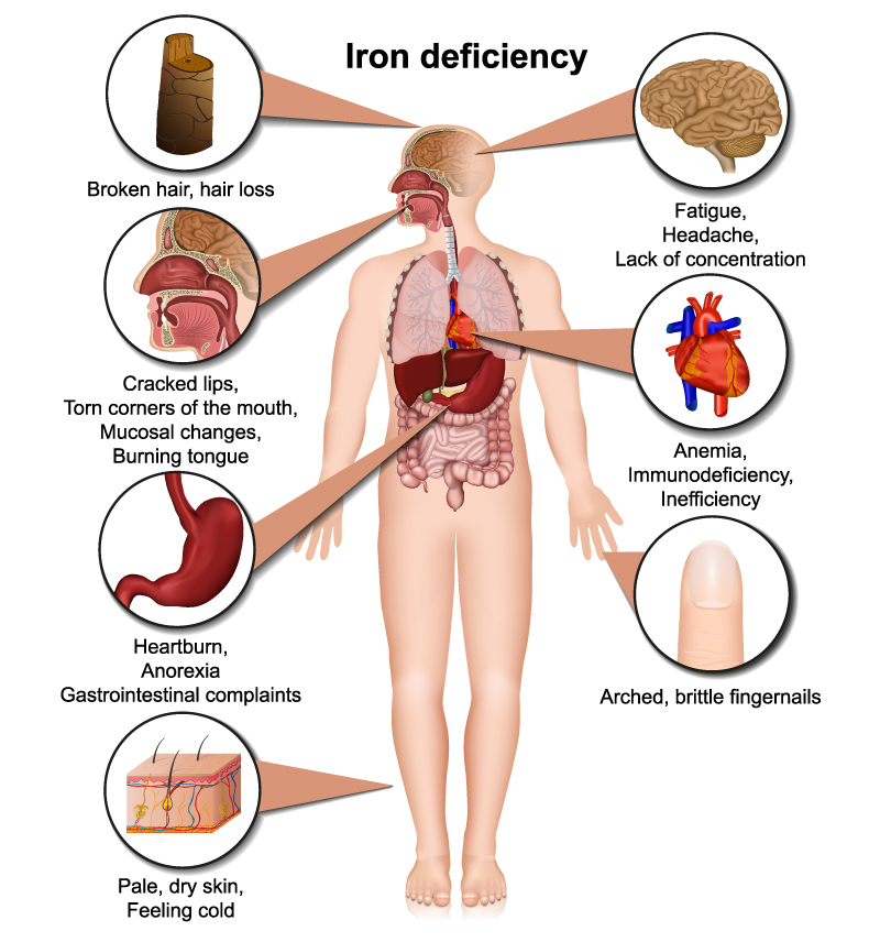 Anemia: Overview, Types, Causes, Signs And Symptoms, Treatment, Prevention And Complications