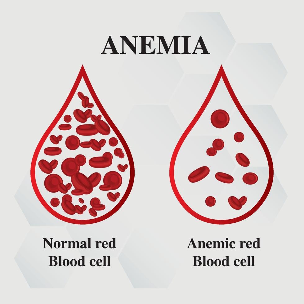 Anemia: Overview, Types, Causes, Signs And Symptoms, Treatment, Prevention And Complications