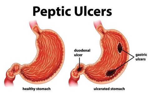 Peptic Ulcer Disease: Overview, Types, Causes, Signs And Symptoms, Treatment, Prevention And Complications