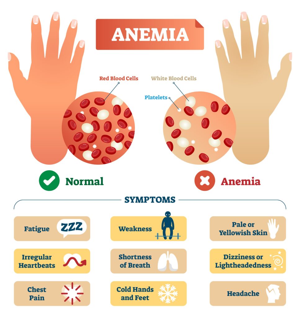 Anemia: Overview, Types, Causes, Signs And Symptoms, Treatment, Prevention And Complications