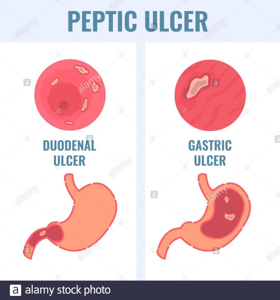 Peptic Ulcer Disease: Overview, Types, Causes, Signs And Symptoms, Treatment, Prevention And Complications