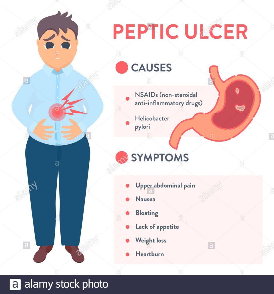 Peptic Ulcer Disease: Overview, Types, Causes, Signs And Symptoms, Treatment, Prevention And Complications